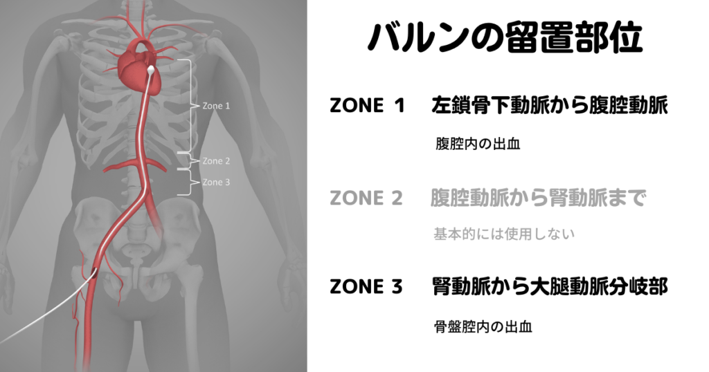 バルンの留置位置